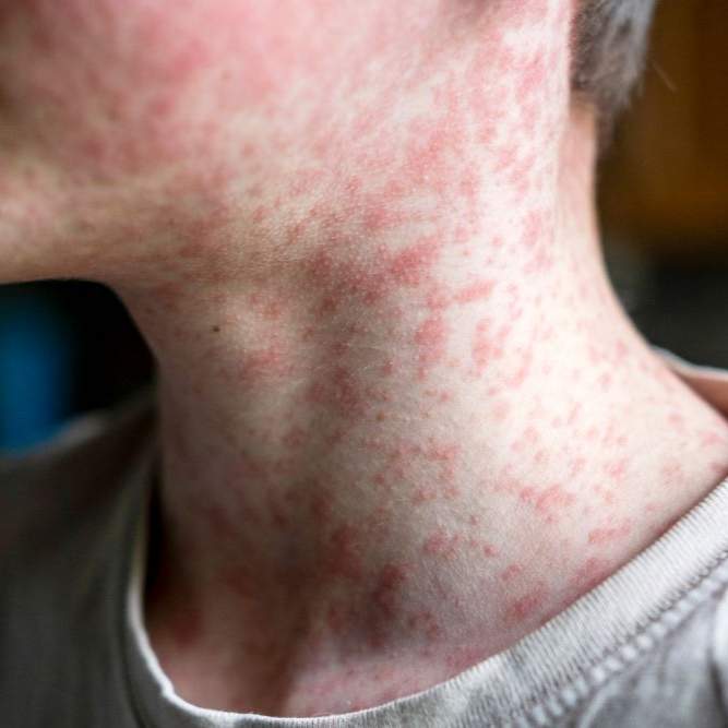 measles1